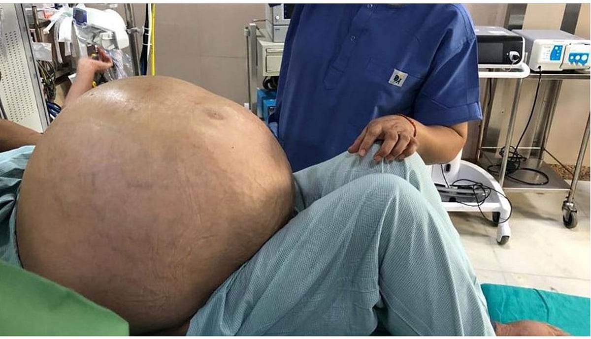 இந்தூரில் பெண்ணின் வயிற்றில் இருந்த 3 கிலோ எடை கொண்ட கட்டி வெற்றிகரமாக அகற்றப்பட்டது